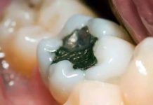 दांतों के कीड़ों को जड़ से खत्म करने का आसान घरेलू उपाय