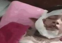 भोपाल में आवारा कुत्ते का आतंक: घर में घुसकर 8 साल के इब्राहिम को बुरी तरह नोंचा, चेहरे की करानी पड़ी सर्जरी; 5 दिन में 15 लोगों पर हमले से इलाके में दहशत